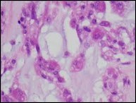 Parachordoma exemplifying clusters and nests of spherical, vacuolated cells with abundant, acidophilic cytoplasm, regular nuclei and an enveloping cartilaginous stroma 14.