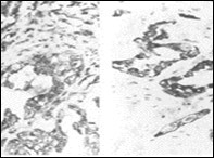 Parachordoma depicting cords and aggregates of vacuolated cells with acidophilic cytoplasm and regular, miniature nuclei with an encompassing myxoid stroma 15.