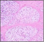Parachordoma exhibiting nests and clusters of spheroidal cells with eosinophilic, vacuolated cytoplasm, uniform, bland nuclei and a circumscribing myxoid stroma 15.