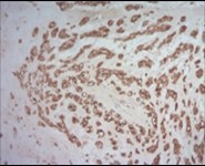 Parachordoma depicting immune reactivity to S100 protein 16.