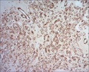 Parachordoma demonstrating immune reactivity to vimentin 16.