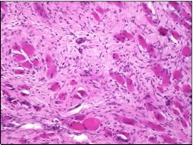 Fibromatosis colli depicting bundles of fibroblasts and myo-fibroblasts intermixed with a collagenous stroma and entrapped myocytes 9.