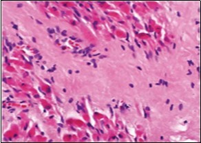 Fibromatosis colli demonstrating fascicles of fibroblasts and myo-fibroblasts within an abundant collagenous stroma and several mature myocytes 10.