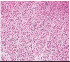 Fibromatosis colli depicting fascicles of fibroblasts and myo-fibroblasts admixed with a collagenous stroma and extravasation of numerous red blood cells 10.