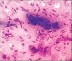 Fine needle aspiration cytology of fibromatosis colli delineating aggregates of plump, spindle-shaped cells admixed with fibroblasts, fibro-connective tissue fragments and intermingled red cell extravasation 11