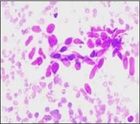 Fine needle aspiration cytology of fibromatosis colli exhibiting aggregates of spindle- shaped cells, plump fibroblasts, fibro-connective tissue fragments and a clear background with minimal red cell extravasation 12.