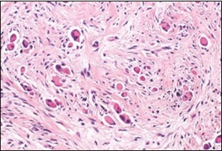 Fibromatosis colli exhibiting fibroblasts, myo-fibroblasts and an abundant collagenous stroma with commixture of enlarged myocytes 14.