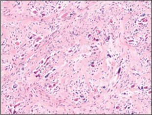 Fibromatosis colli enunciating fibroblasts, myo-fibroblasts and collagenous stroma with dispersed mature myocytes 14.