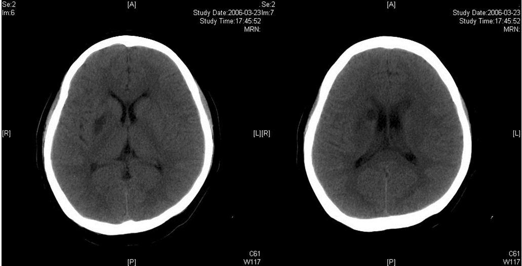 Two infarcts displayed in CT images