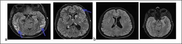 The brain MRI with flair sequences showing bi-temporal and frontal hyper signals (a) and a complete decrease of lesions after treatment (b).