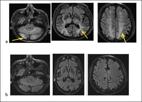 Brain MRI with flair sequences showing hyper signals of white matter and cerebellum corresponding to edema (a) and the decrease of lesions after treatment (b).