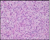 Low grade fibromyxoid sarcoma demonstrating alternating fibrous and myxoid areas comprised of uniform spindle-shaped cells (11).