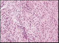 Low grade fibromyxoid sarcoma composed of alternating foci of fibrous and myxoid region with interwoven fascicles and bland spindle-shaped tumour cells (12).