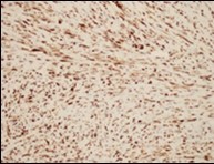 Low grade fibromyxoid sarcoma immune reactive to MUC4(14).