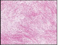 Low grade fibromyxoid sarcoma depicting alternating fibrous and myxoid regions with bland, spindle-shaped tumour cells and absent mitosis (15).