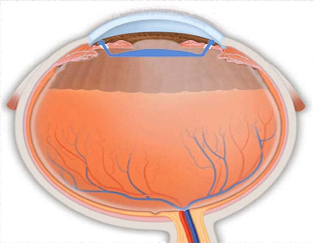 Diagrammatic cross section of the eye showing the position of the new IOL inside the eye, with the optic in the posterior chamber and the haptics in the anterior chamber angle.