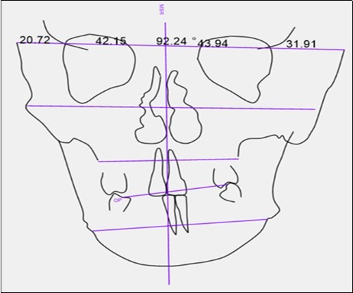 Transverse planes in the Grummons and Kappeyne Van De Kopello PA cephalometric analysis and evaluation of upper facial floor transverse asymmetry