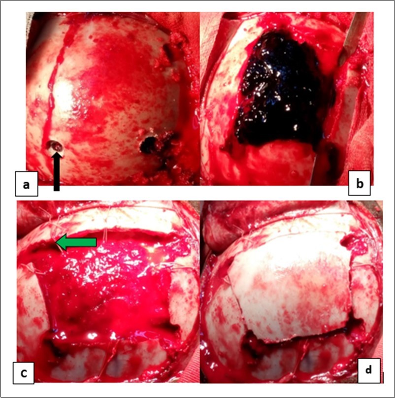 Operating times for an extra dural hematoma: a) making a cranial bone flap with three drill holes (the black arrows); b) extra dural hematoma after craniotomy (by the blue arrows); c) image showing the dura mater then suspension of the dura mater (the green arrows) and d) image after handing over the bone flap.