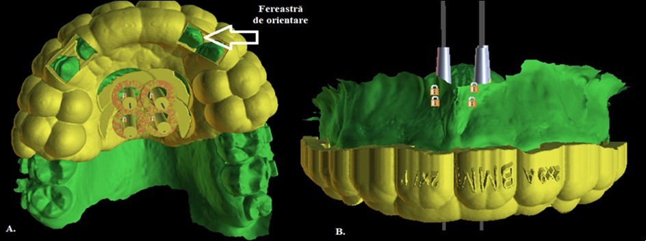 Designing the surgical guide