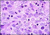 Angiomatoid fibrous histiocytoma enunciating elliptical and spindle-shaped cells with moderate eosinophilic cytoplasm and intermixed lymphocytes and plasma cells 10.