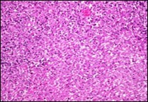 Angiomatoid fibrous histiocytoma exhibiting spherical to elliptical cells comingled with abundant vascularized stroma and a peripheral accumulation of small lymphocytes with plasma cells 11.