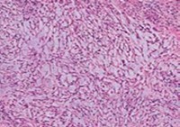 Angiomatoid fibrous histiocytoma enunciating a multinodular pattern with elongated cells, vascular tumour stroma and a border of lymphocytes and plasma cells12.