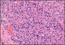 Angiomatoid fibrous histiocytoma exemplifying uniform, spindle-shaped tumour cells with peripheral lymphocytic cuffing and a vascularized tumour matrix13.