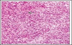 Angiomatoid fibrous histiocytoma depicting tumour nodules of elliptical cells with a cuff of lymphoid and plasma intermixed with a vascular matrix 15.