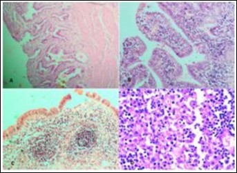 Photomicrographs showing A, Rokitansky agghste sinuses characteristic of chronic cholecystitis; B, Acute on Chronic Cholecystitis; C, Follicular Cholecystitis; D, Foamy macrophages admixed with mcaumulaig inflammatory infiltrate seen in Zbanikagmapincitma Cholecystitis (H&E)