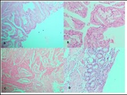 Photomicrograph showing A, cib;k%=Ss in low power; B, High power view of CiNk%=1%us showing lipid laden macrophages; C,ggtj of Gall Bladder; D, Pyloric Metaplasia Gall Bladder (H&E)