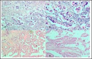 Photomicrograph showing A, Low power view of Adenocarcinoma Gall bladder; B, High power view shows attempted gland formation with moderate pleomorphismmoderately differentiated adenocarcinoma Gall Bladder; C, Low power view of Papillary carcinoma GB; D, High power view showing papillae with fibrovascular cores lined by malignant cells- Papillary carcinoma GB (H&E)