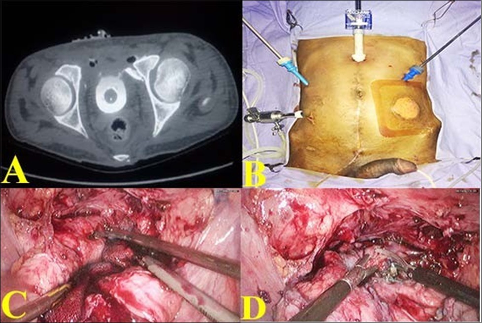 A. Pre-operative CT showing contrast extravasation in anterior wall with bony spicule; B. Port Placement for bladder repair; C. Bladder rent identified by methylene blue; D. Two defects joined into a single cystotomy