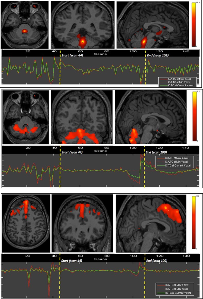 First experiment showing both BOLD signal time courses and activated areas: dorsal pons (1st row), anterior and posterior vermis as well as superior and lateral aspects of the cerebellar hemispheres (2nd row), dorsomedial prefrontal cortex (3rd row), and primary visual cortex (last row).