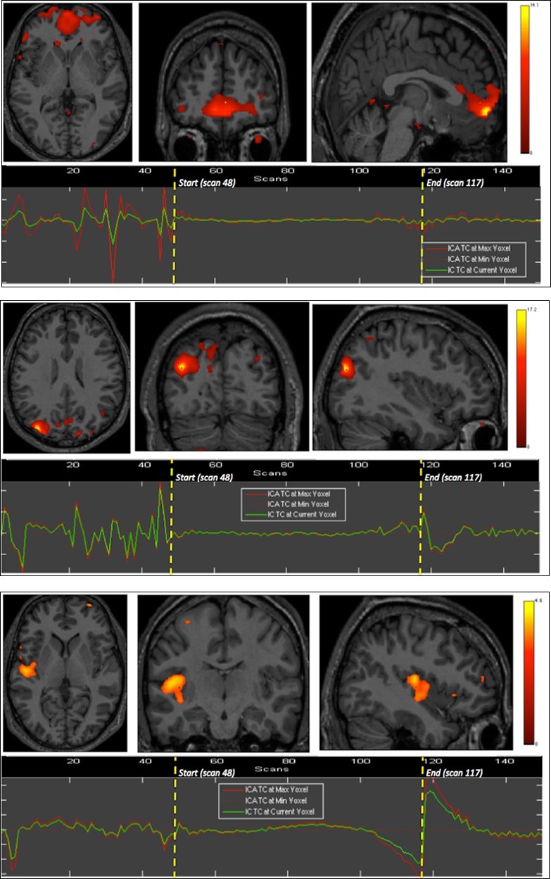 Second experiment showing BOLD time courses and activation of ventromedial prefrontal cortex (upper row) and inferior parietal cortex including the angular gyrus (middle row) and the supramarginal gyrus (lower row).