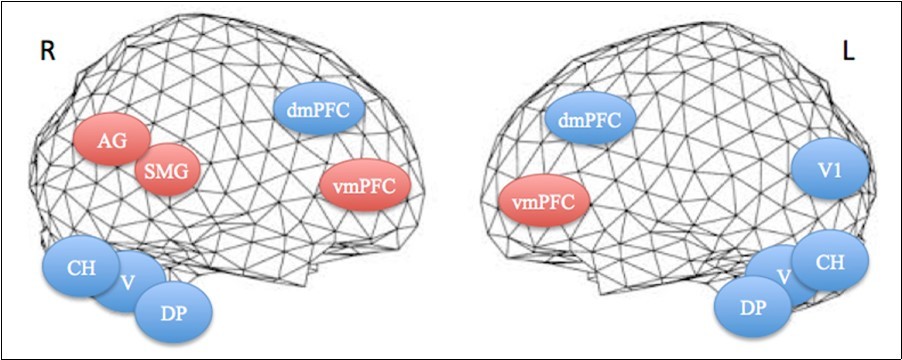 Projections of activated areas on a brain mesh showing networks involved in the first apnea (blue labels) and second apnea (red labels). Dorsomedial (dmPFC) and ventromedial prefrontal cortices (vmPFC), dorsal pons (DP), vermis (V) and cerebellar hemispheres (CH) are activated bilaterally, while inferior parietal cortex, including the angular gyrus (AG) and the supramarginal gyrus (SMG), is on the right hemisphere and medial visual cortex (V1) on the left one. R=right. L=left.