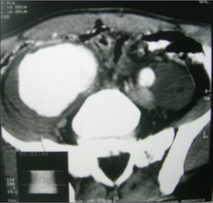 Angio CT scan revealed an aneurysm of the right common iliac artery.