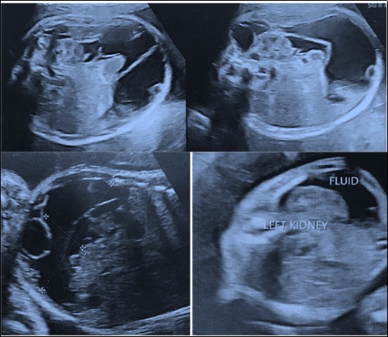 Images of Ultrasonography at second trimester of pregnancy