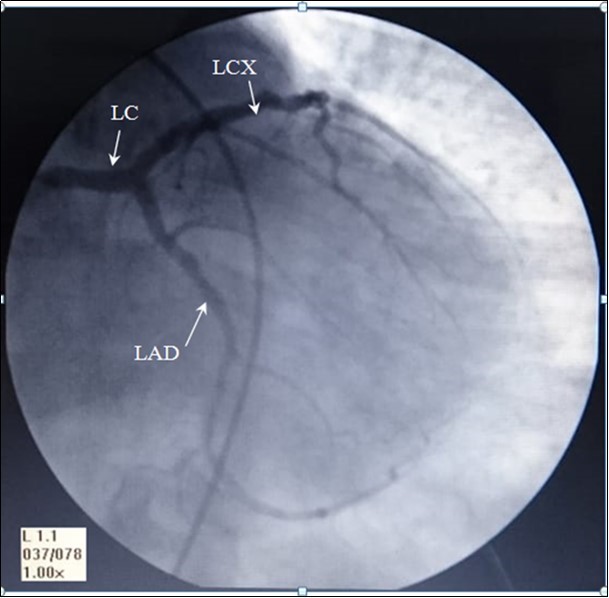 AP- anteroposterior angiographic view showing, Left coronary artery: LC, left anterior interventricular ( anterior descending) artery: LAD, and Left Circumflex artery: LCX