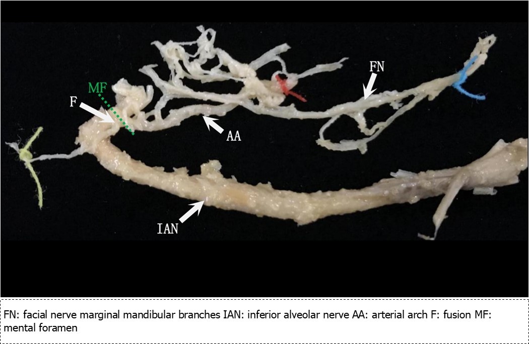 Mental nerve trunk and facial nerve contiguous with the inferior alveolar nerve removed from the mandibular canal