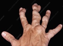 Enchondroma depicting skeletal deformity with tumour nodules confined to small tubular bones of the hand 10.