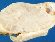 Enchondroma delineating a glistening, grey/white cut surface with an encapsulated, well circumscribed tumour 11.