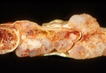 Enchondroma exhibiting a nodular, encapsulated, well circumscribed, lobulated appearance 12.