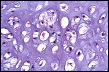 Enchondroma depicting lobules of hyaline cartilage with vacuolated cells and eccentric nuclei 12.