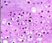 Enchondroma enunciating lobules of uniform cartilaginous cells with regular, centric nuclei and absence of mitosis 13.