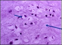Enchondroma exemplifying lobules of hyaline cartilage composed of enlarged, vacuolated cells with uniform nuclei. Focal calcification is absent 14