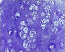 Enchondroma enunciating lobular hyaline cartilage with constituent vacuolated chondrocytes an uniform nuclei 15.
