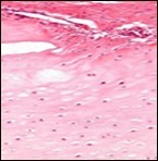 Enchondroma delineating hyaline cartilaginous cells with vacuolated cytoplasm and uniform nuclei 16.