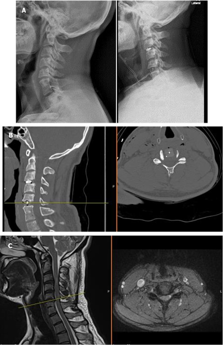 X-ray, computerized tomography, and magnetic resonance imaging views of a Yilmaz-Yucesoy Classification System Grade 2 patient.