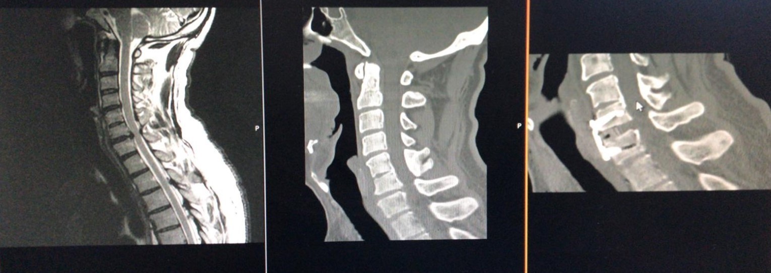 Computerized tomography, and magnetic resonance imaging views of a Yilmaz-Yucesoy Classification System Grade 3 patient who underwent anterior cervical discectomy and fusion with cervical cage and plate.