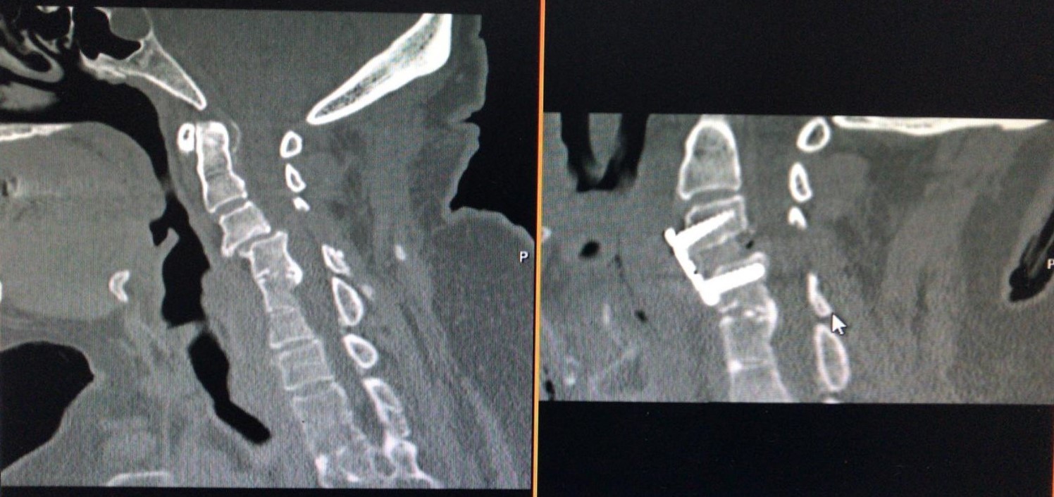 Computerized tomography scans of a Yilmaz-Yucesoy Classification System Grade 4 patient who underwent anterior cervical discectomy and fusion with cervical cage and plate.